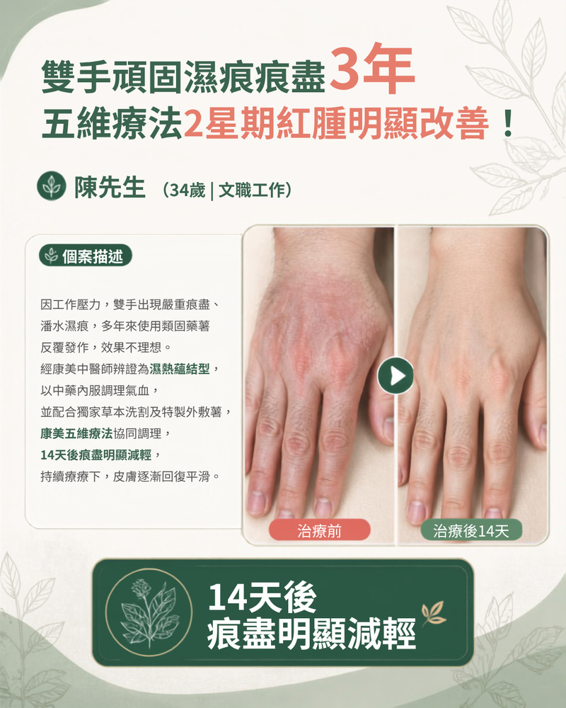 雙手頑固濕疹痕癢3年,五聯療法2週顯著退紅!
